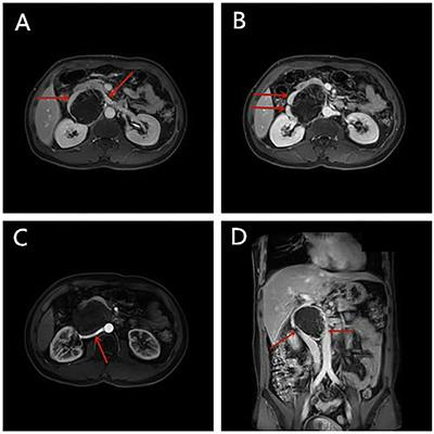 Clinical Characteristics and Treatment Strategy of Retroperitoneal Schwannoma Adjacent to Important Abdominal Vessels: Three Case Reports and Literature Review